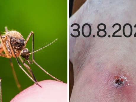 Štípanec od komára sa zmenil na infekciu: Ľudmila skončila u lekára