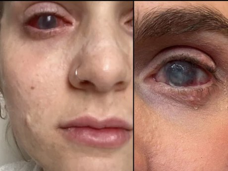Po ibuproféne upadla do kómy a oslepla: Jaqueline podstúpila 26 operácií